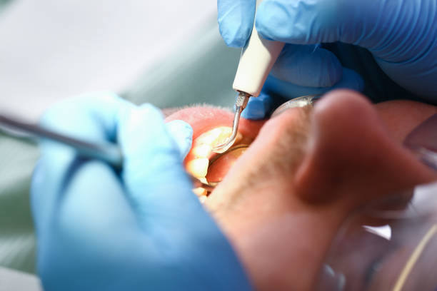 Best Emergency Root Canal Treatment in Oatfield, OR