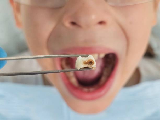 Best Emergency Dental Extractions in Oatfield, OR